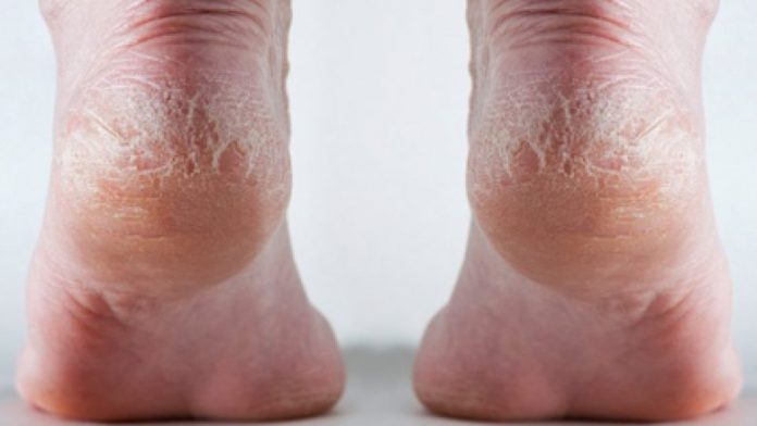 cracked_Heel_final1-780x439