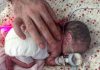 Feston 2 vjetorin, foshnja që lindi 23 javëshe dhe që peshonte 450 gram