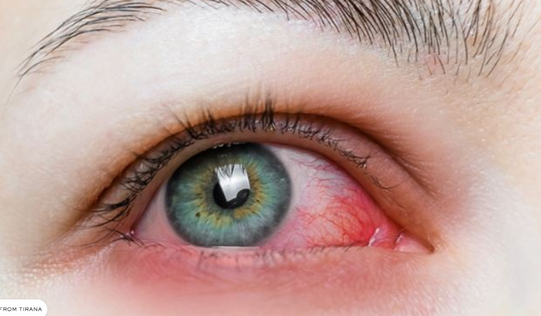 Tensioni i syrit  shenjat kur duhet të shkoni patjetër te mjeku 